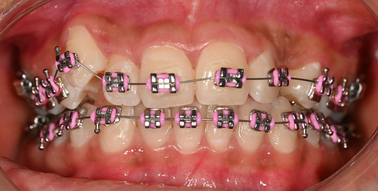 Braces treatment case