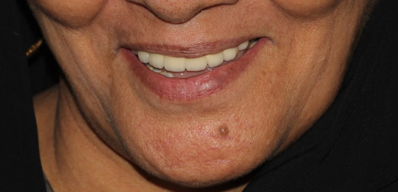 Full mouth rehabilitation, after treatment
