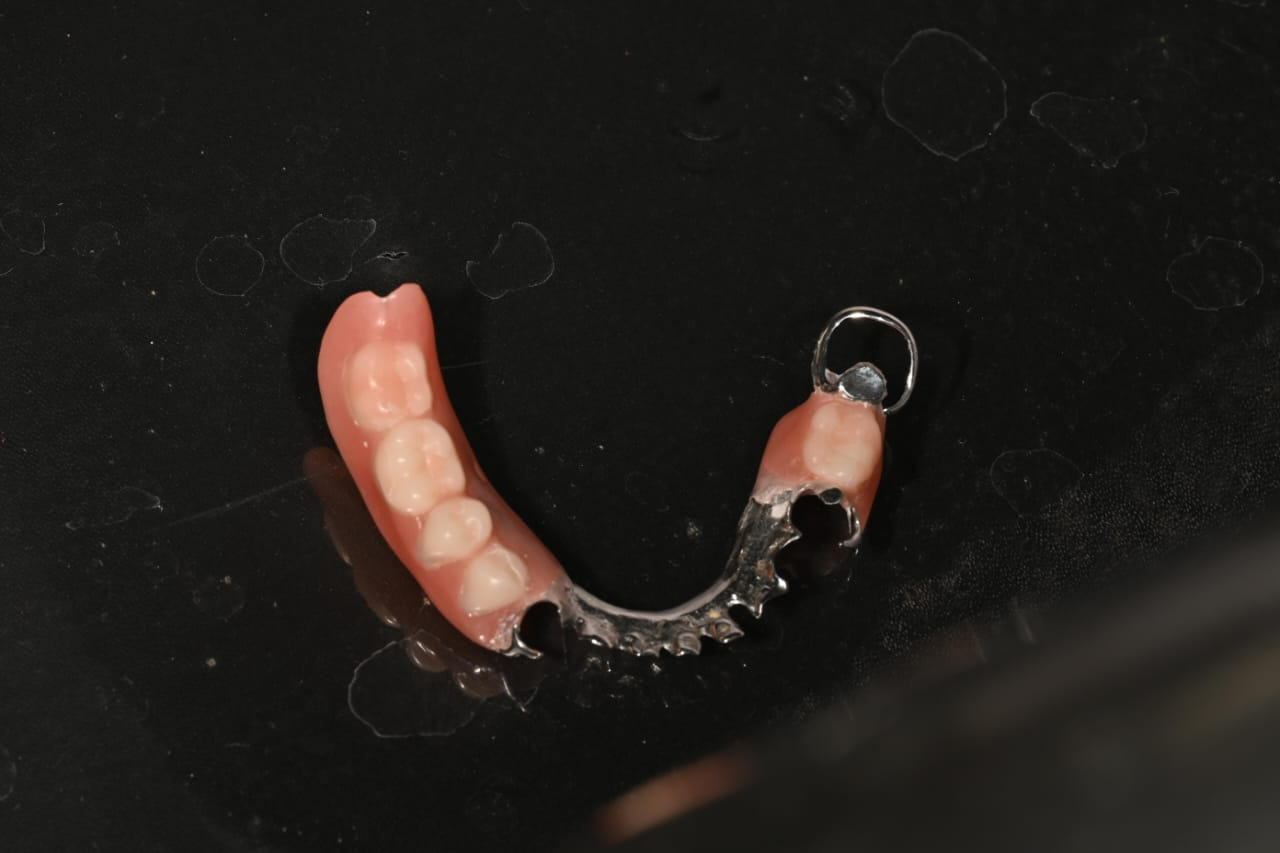 Cast partial denture case