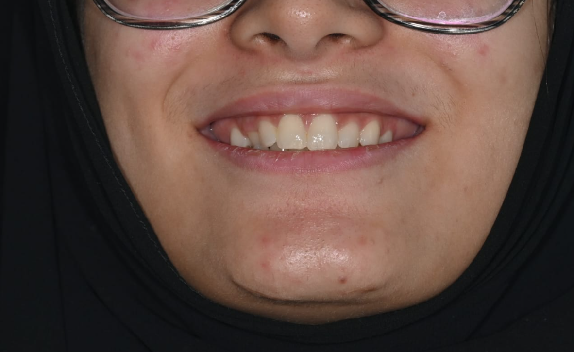 Smile makeover, before treatment